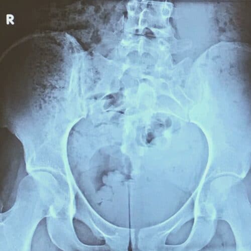 Røntgenbillede af rygsøjle og bækken
